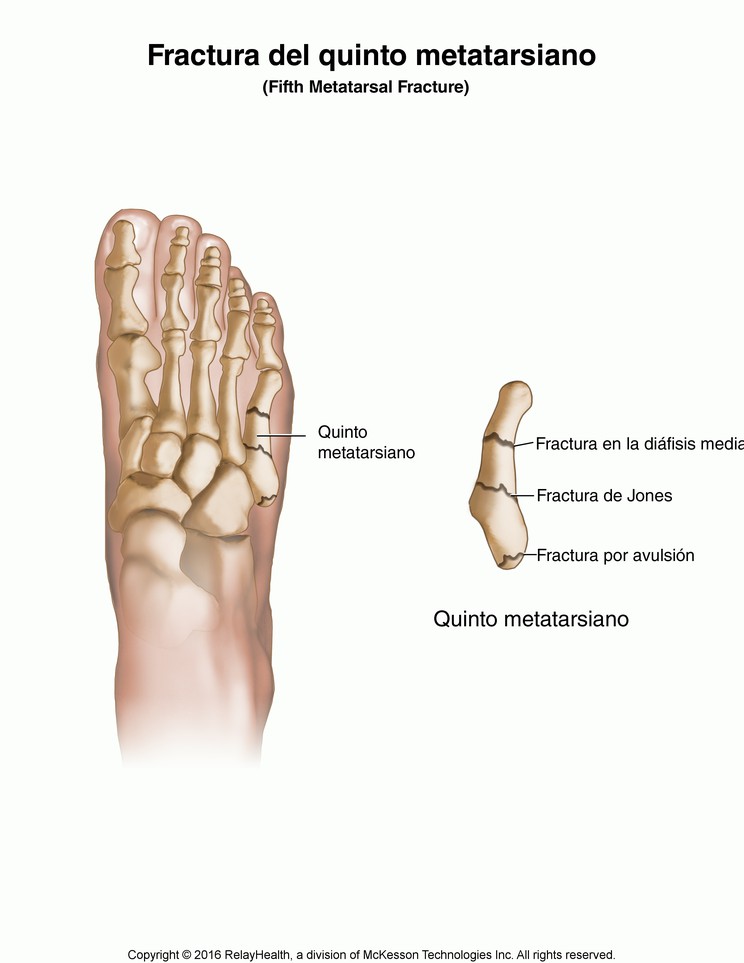 Foot Fracture, Fifth Metatarsal Fracture: Illustration