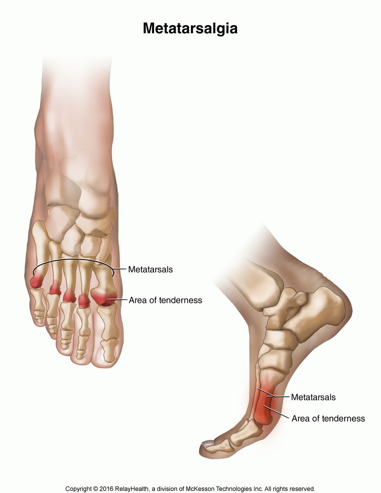 Metatarsalgia: Illustration