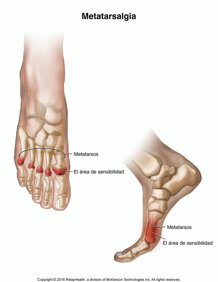 Metatarsalgia: Illustration
