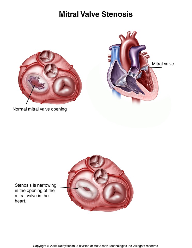 Mitral Valve Stenosis: Illustration