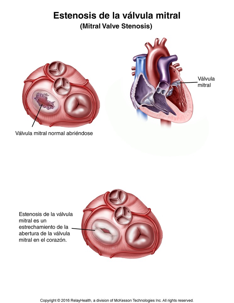 Mitral Valve Stenosis: Illustration