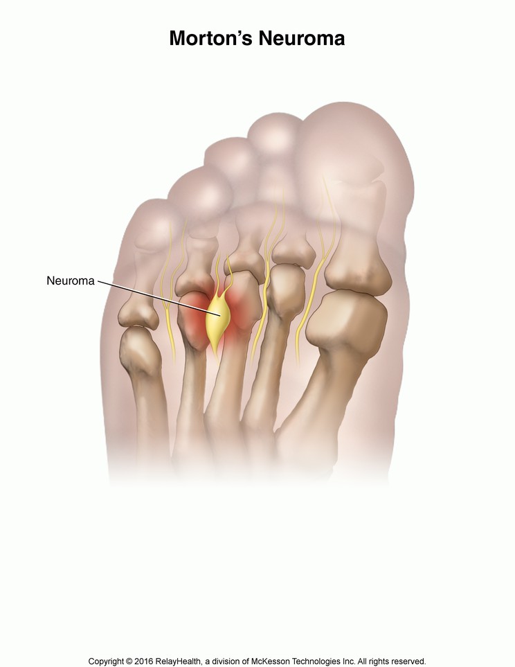 Morton's Neuroma: Illustration