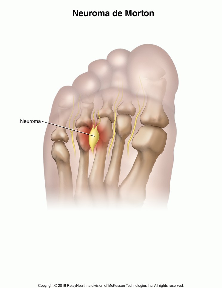 Morton's Neuroma: Illustration
