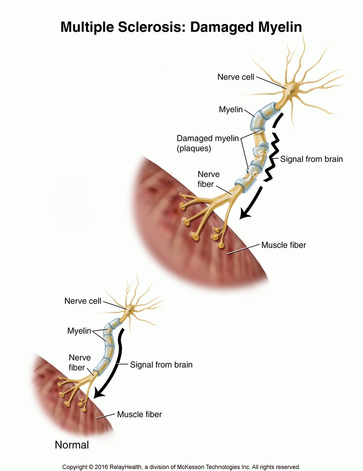 Multiple Sclerosis--Damaged Myelin: Illustration