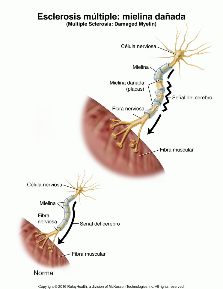 Multiple Sclerosis--Damaged Myelin: Illustration