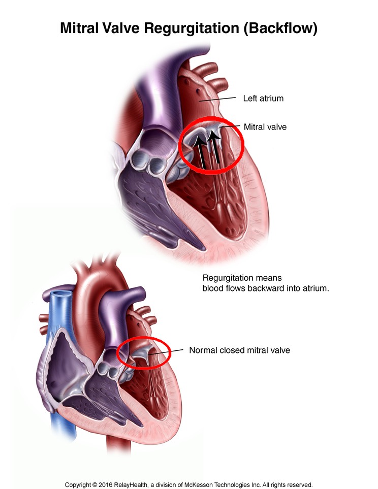 Mitral Valve Regurgitation: Illustration