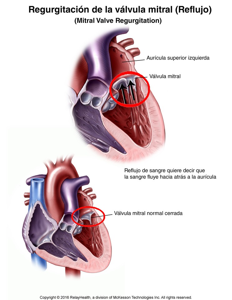 Mitral Valve Regurgitation: Illustration