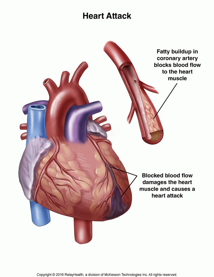 Heart Attack: Illustration
