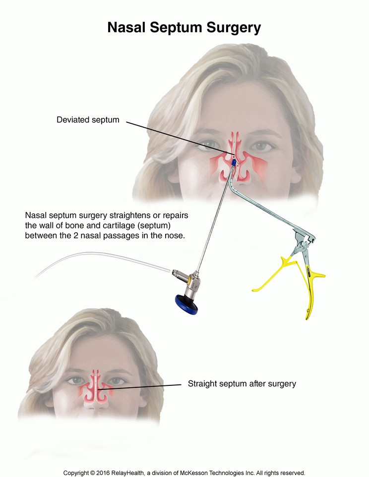 Nasal Septum Surgery: Illustration