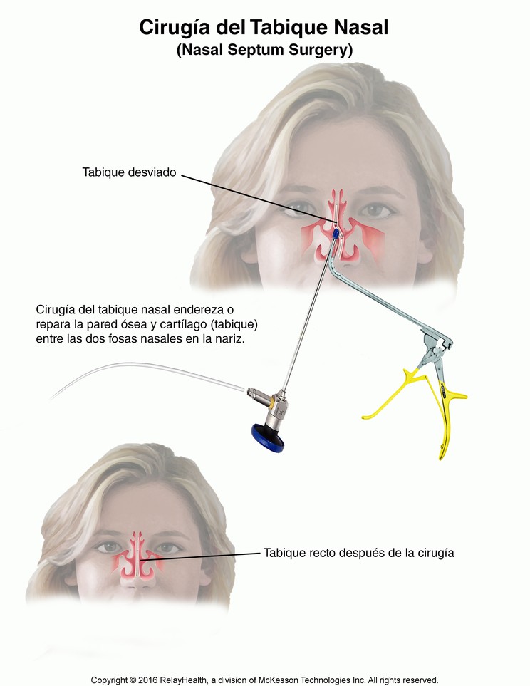 Nasal Septum Surgery: Illustration