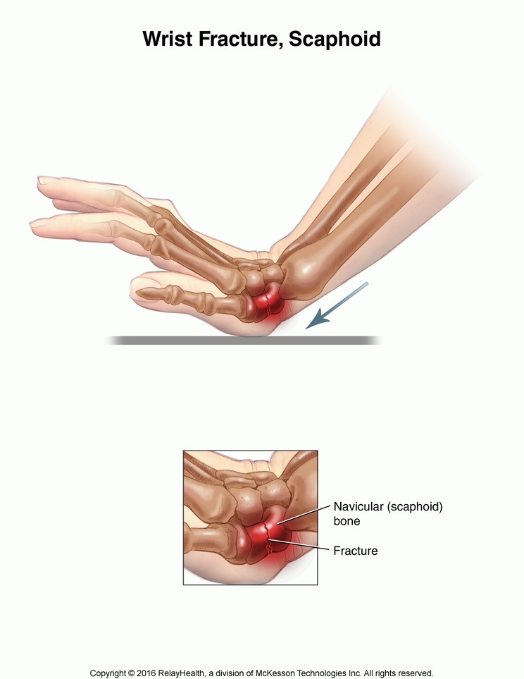 Wrist Fracture, Scaphoid: Illustration