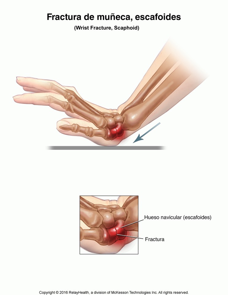 Wrist Fracture, Scaphoid: Illustration