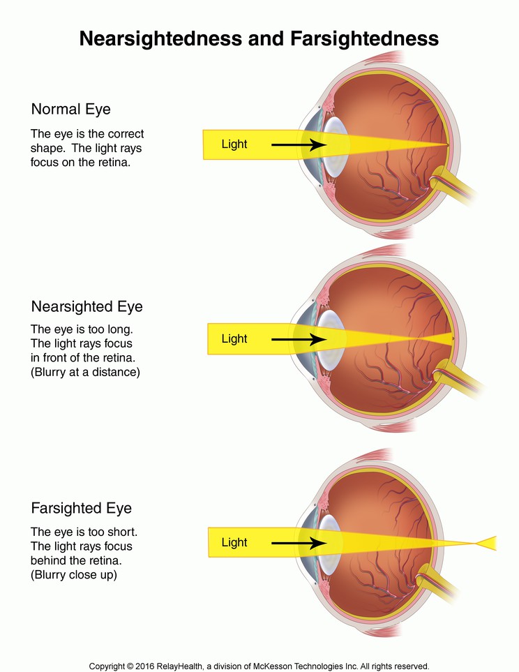 Nearsightedness and Farsightedness: Illustration