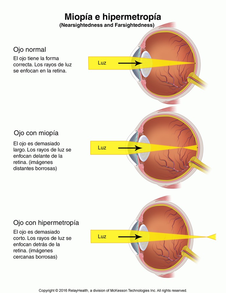 Nearsightedness and Farsightedness: Illustration
