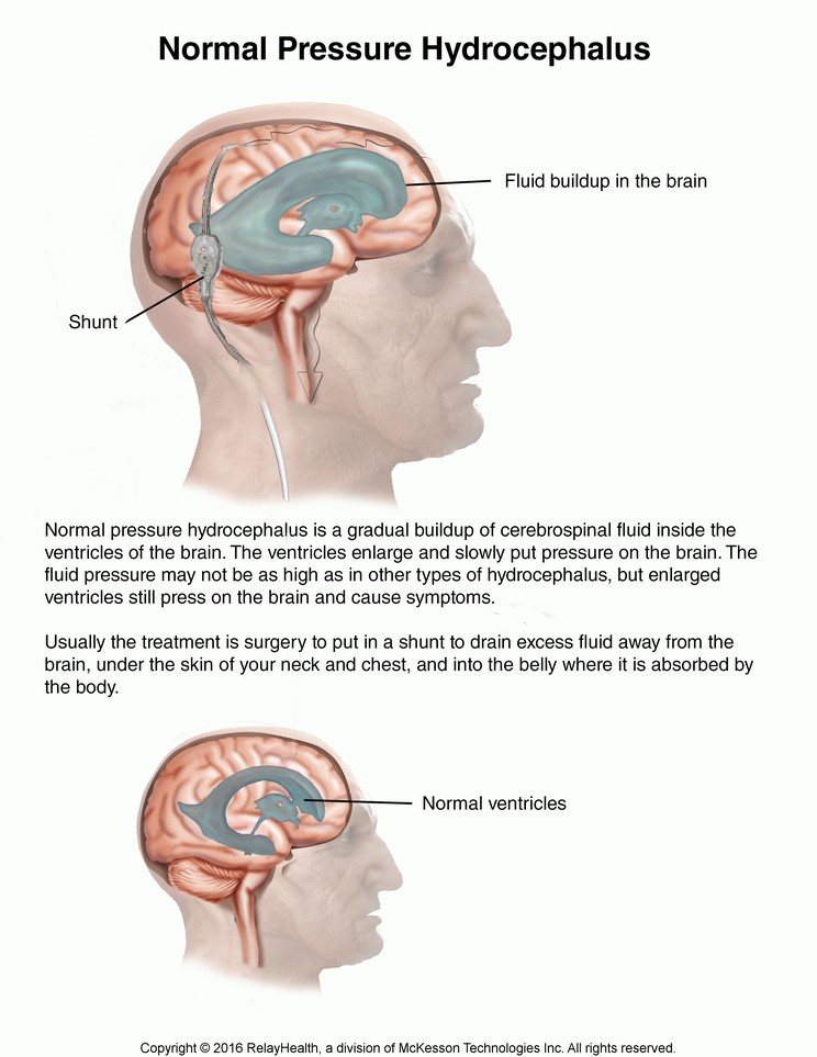 Normal Pressure Hydrocephalus: Illustration