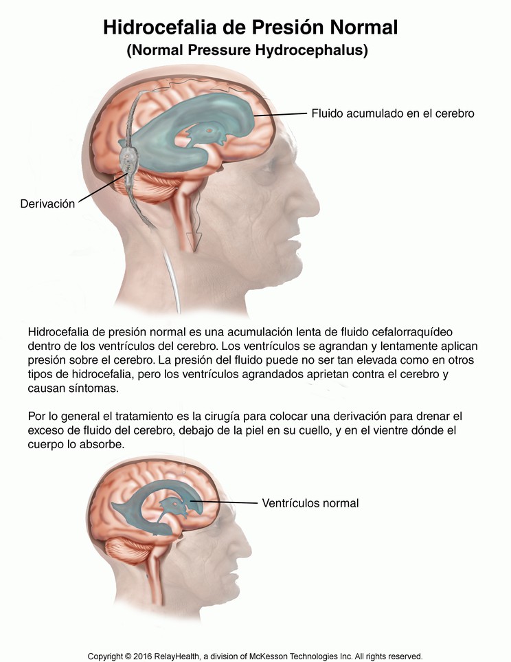 Normal Pressure Hydrocephalus: Illustration