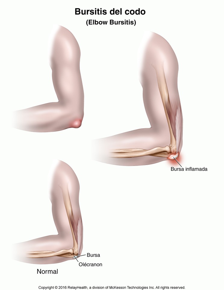 Elbow Bursitis: Illustration