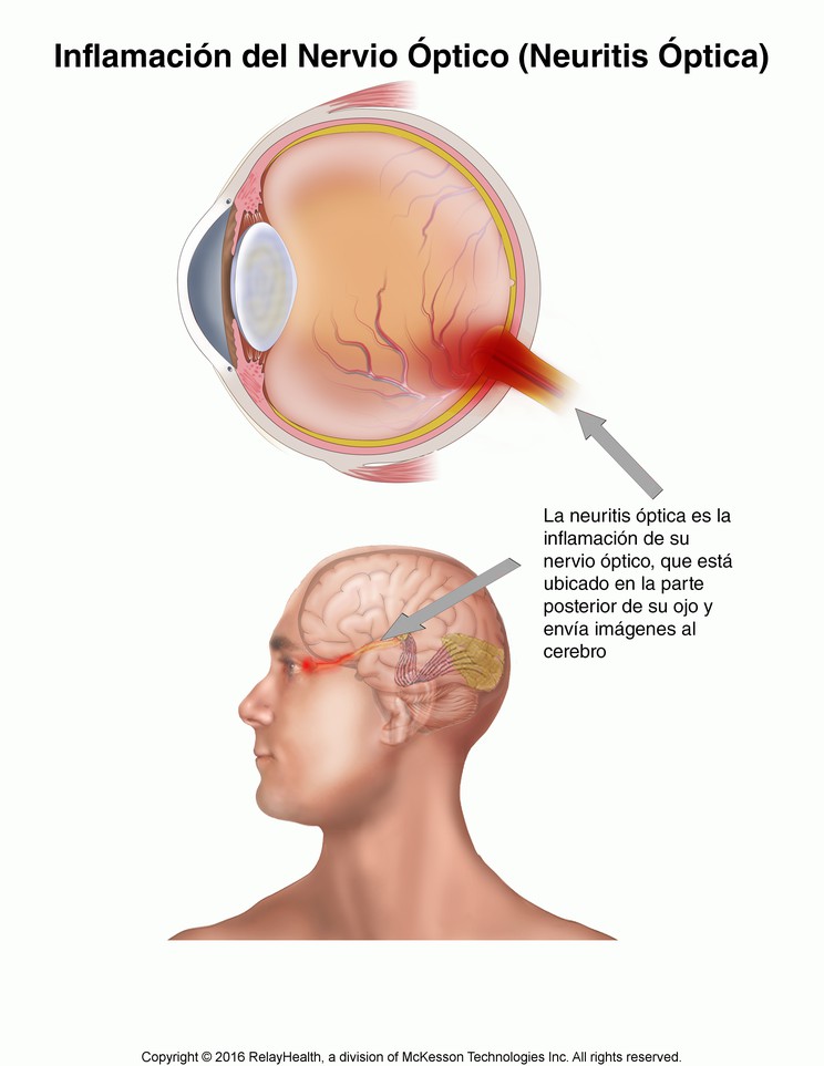 Eye Nerve Inflammation (Optic Neuritis): Illustration