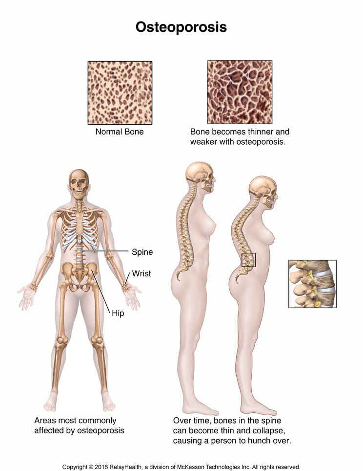 Osteoporosis in Women: Illustration