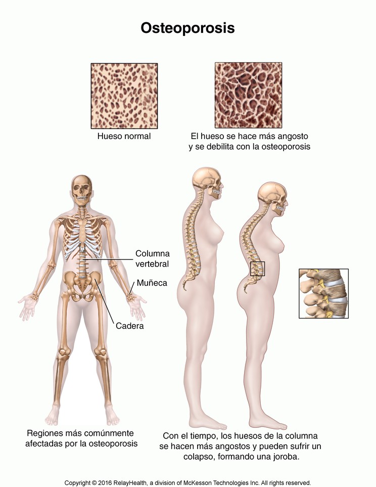 Osteoporosis in Women: Illustration
