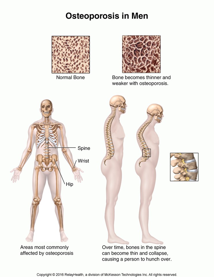 Osteoporosis in Men: Illustration