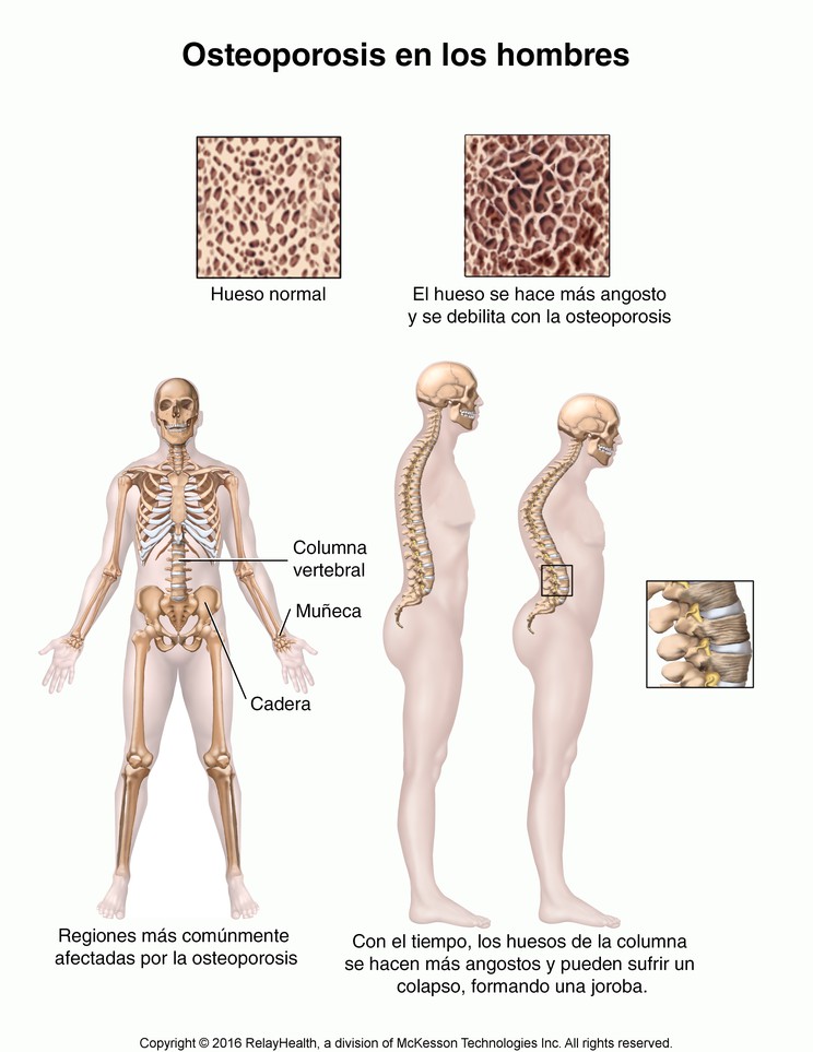 Osteoporosis in Men: Illustration