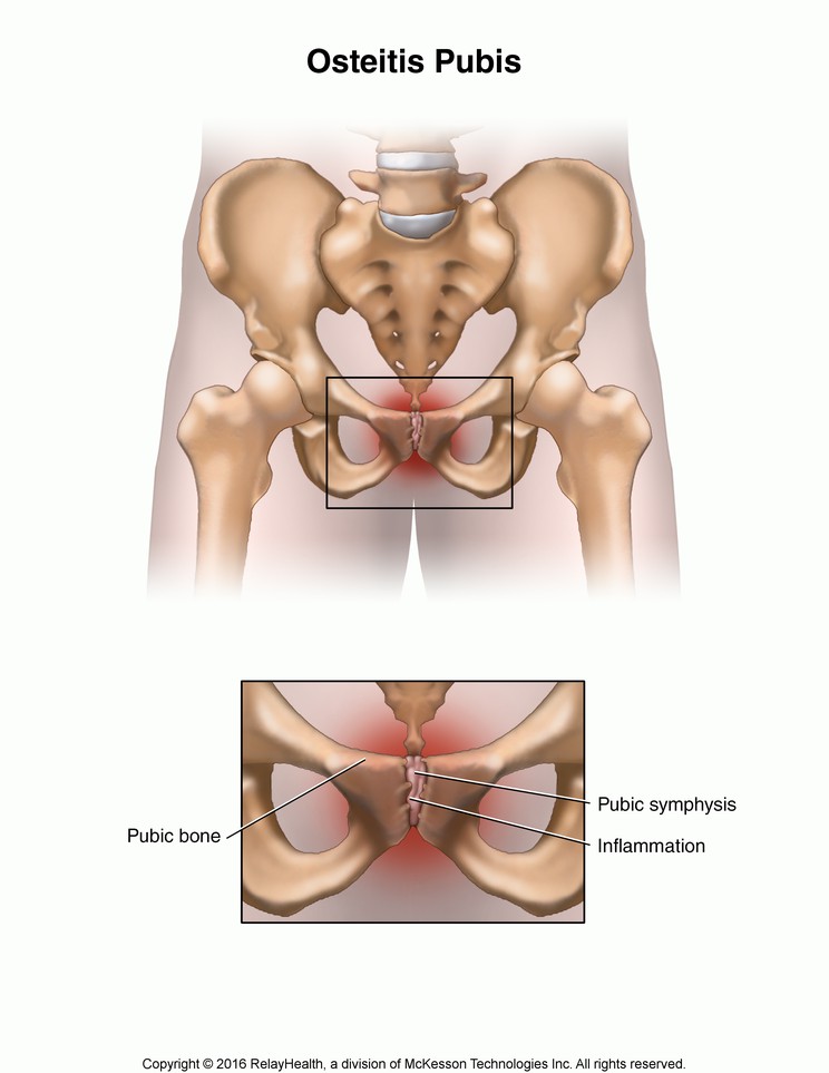 Osteitis Pubis: Illustration