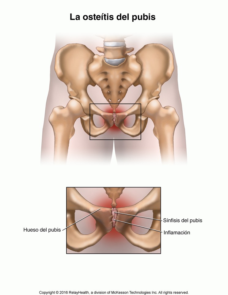 Osteitis Pubis: Illustration