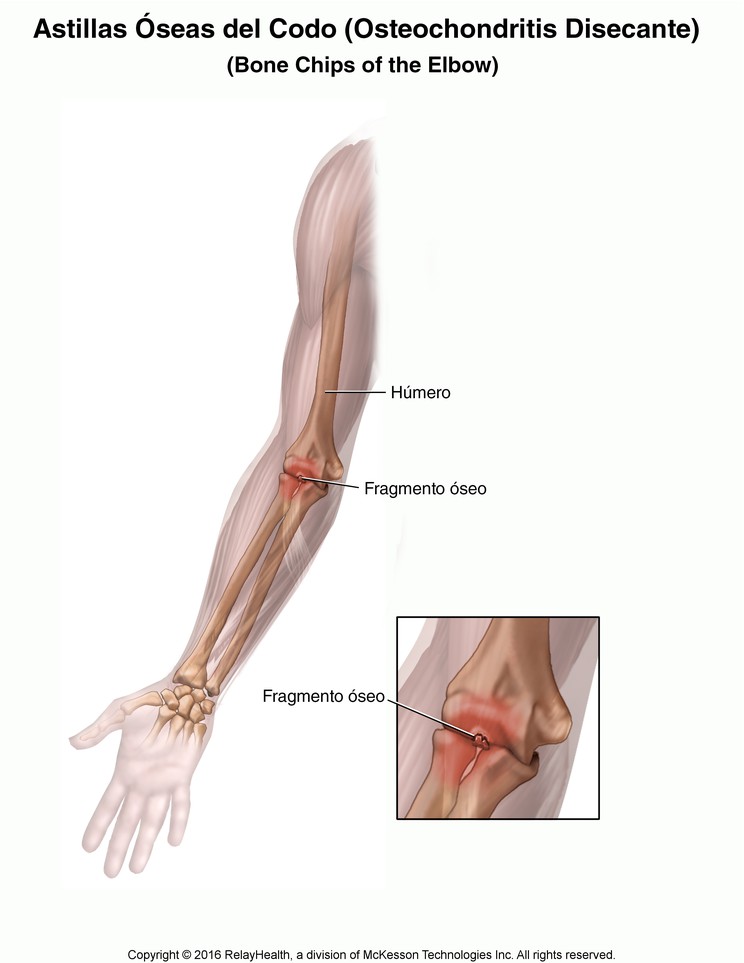 Bone Chips in the Elbow (Osteochondritis Dissecans): Illustration