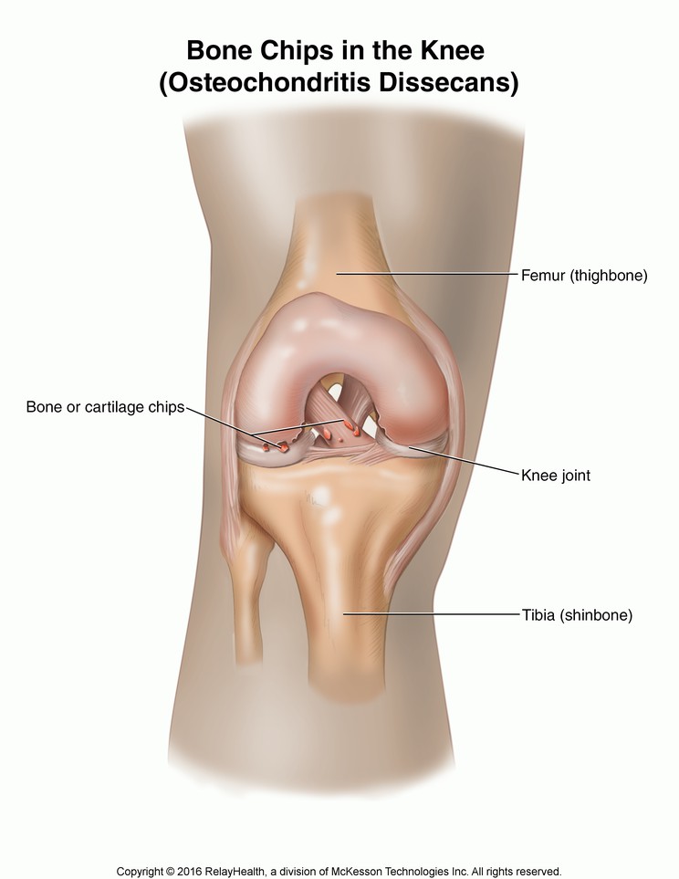 Bone Chips in the Knee (Osteochondritis Dissecans): Illustration