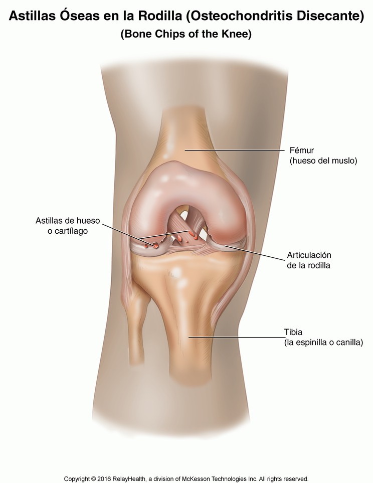 Bone Chips in the Knee (Osteochondritis Dissecans): Illustration