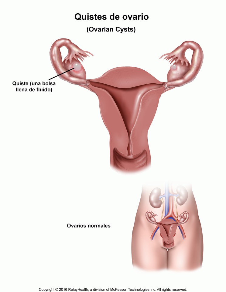 Ovarian Cysts: Illustration