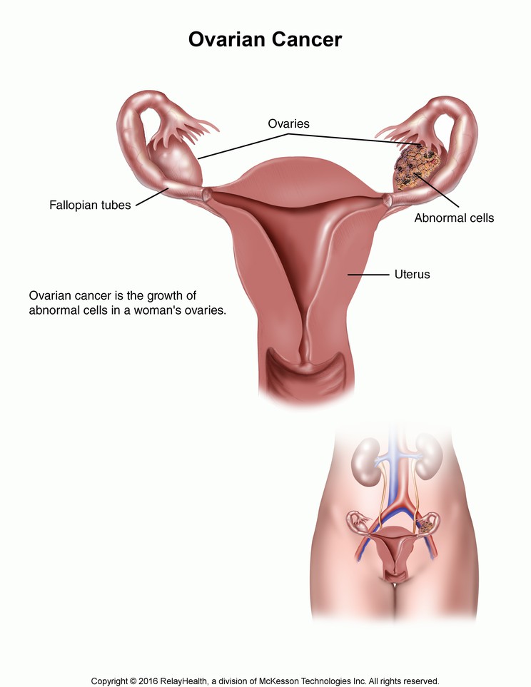 Ovarian Cancer: Illustration