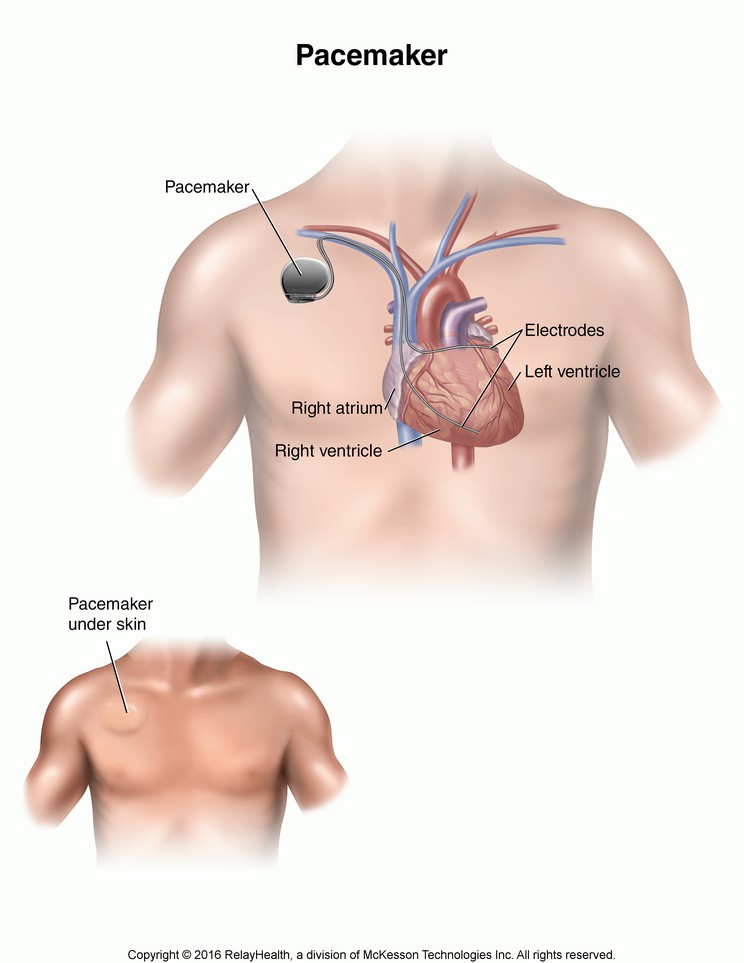 Pacemaker: Illustration