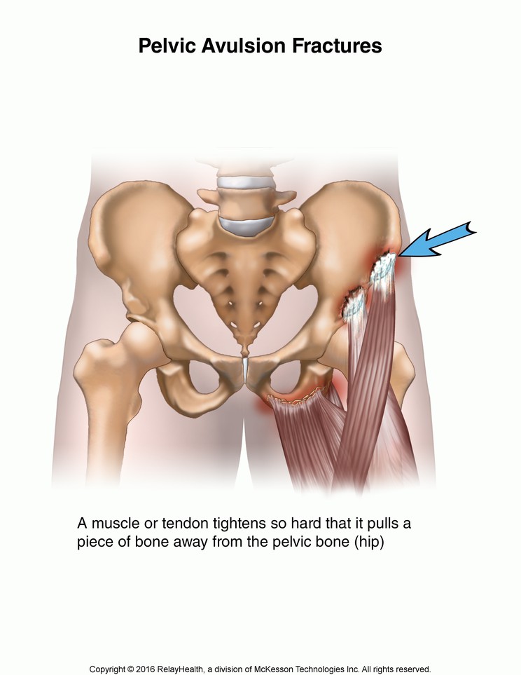 Pelvic Avulsion Fracture: Illustration