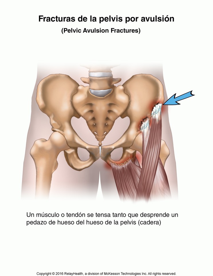 Pelvic Avulsion Fracture: Illustration
