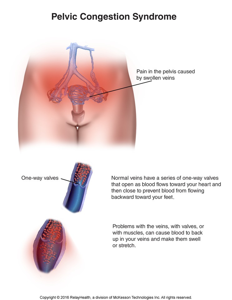 Pelvic Congestion Syndrome: Illustration