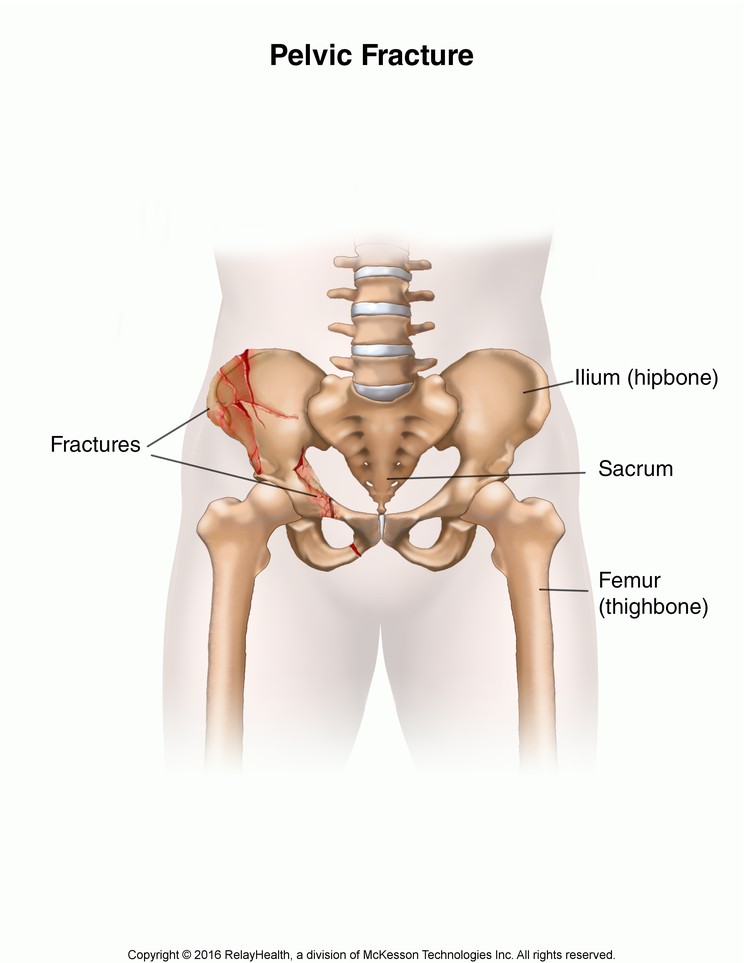 Pelvic Fracture: Illustration