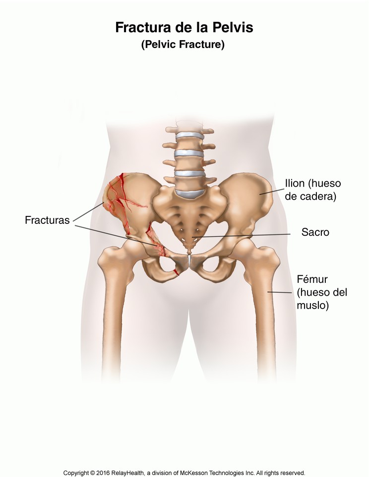 Pelvic Fracture: Illustration
