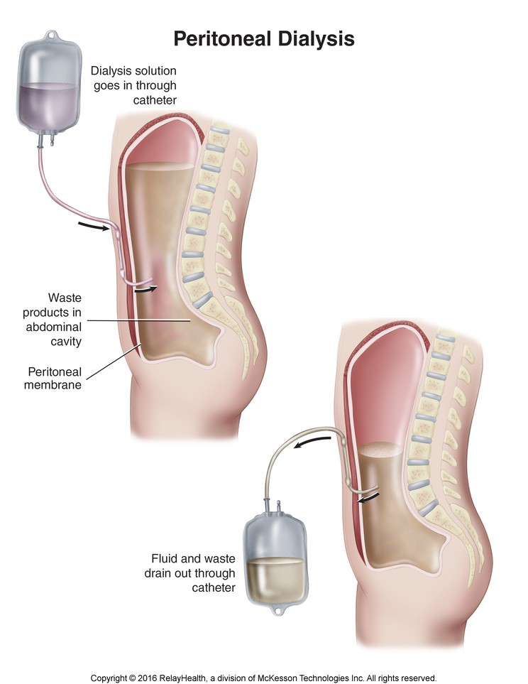 Peritoneal Dialysis: Illustration