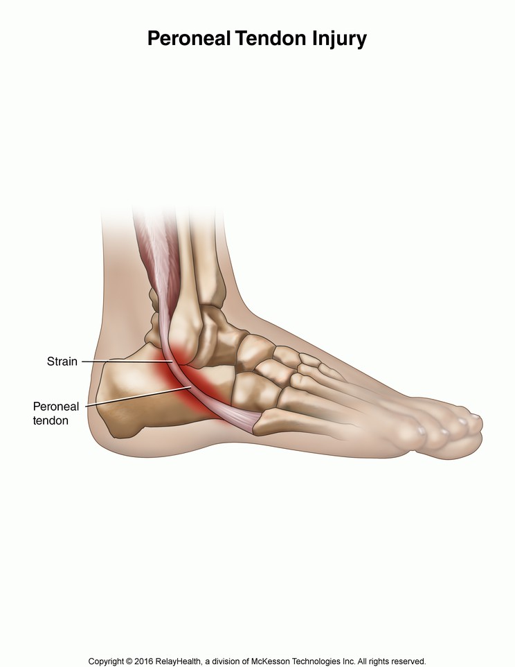Peroneal Tendon Injury: Illustration