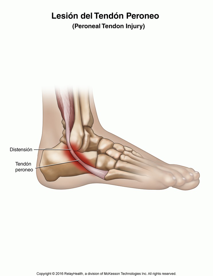 Peroneal Tendon Injury: Illustration