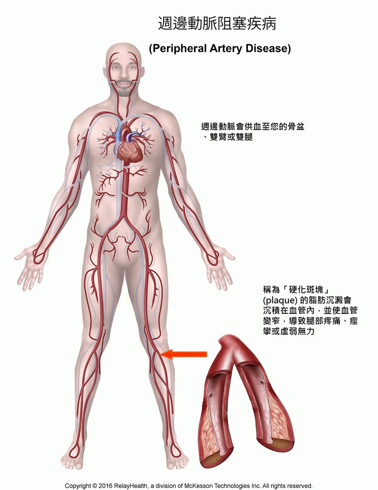 Peripheral Artery Disease: Illustration