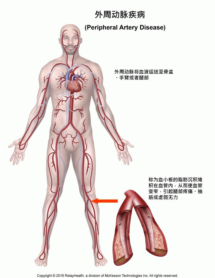 Peripheral Artery Disease: Illustration