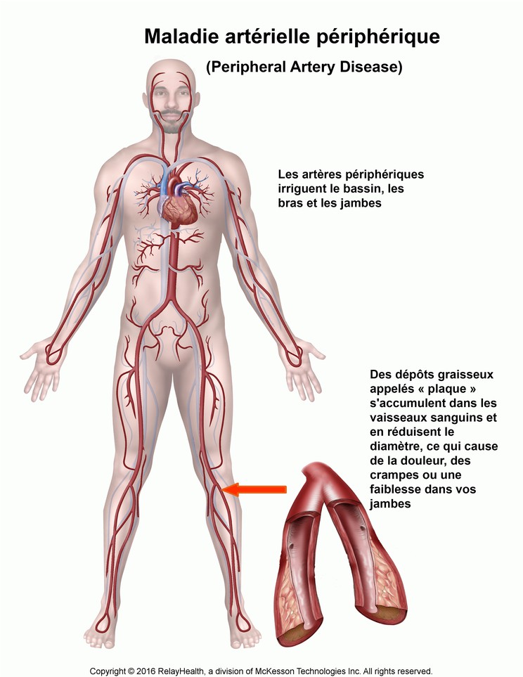 Peripheral Artery Disease: Illustration