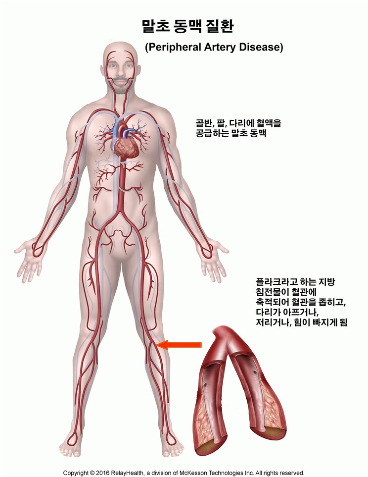 Peripheral Artery Disease: Illustration