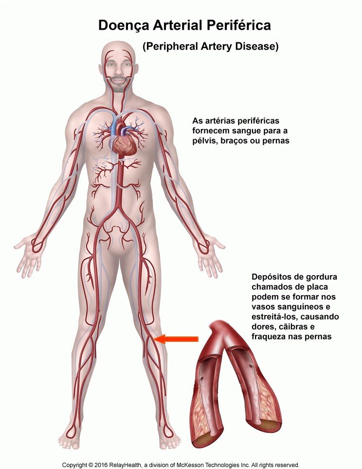 Peripheral Artery Disease: Illustration