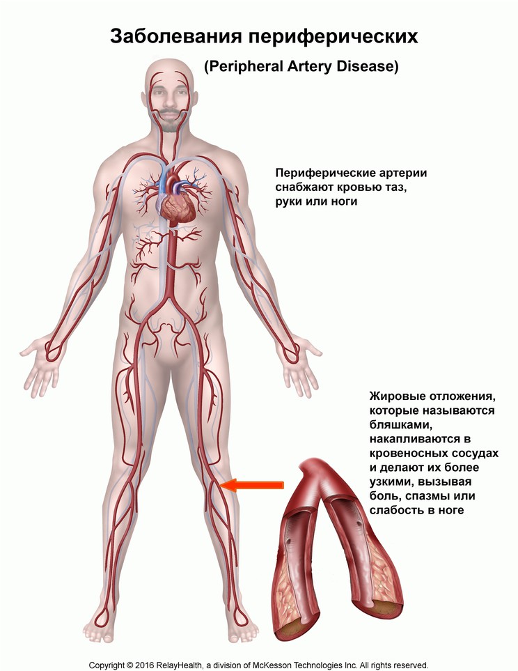 Peripheral Artery Disease: Illustration