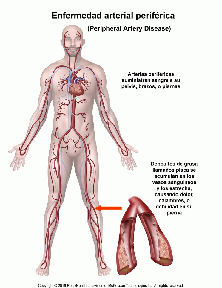 Peripheral Artery Disease: Illustration