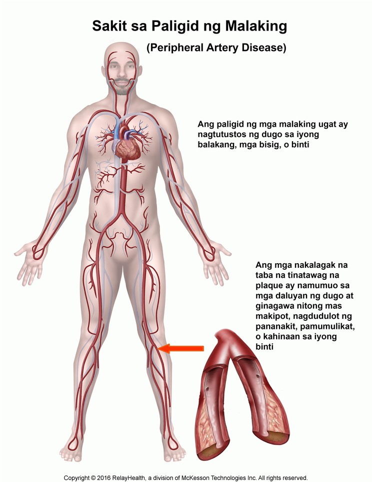 Peripheral Artery Disease: Illustration